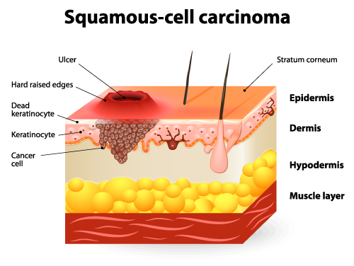 squamous-cell